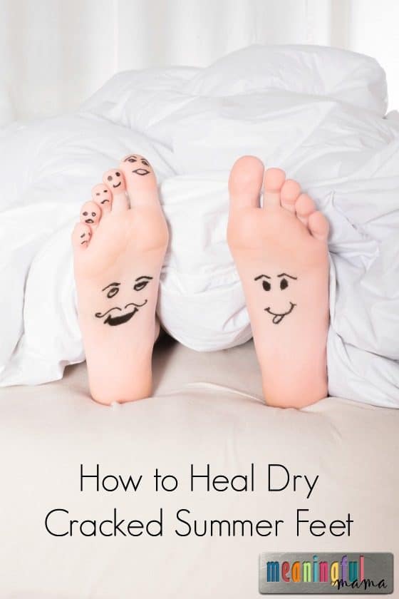 How to Heal Dry Cracked Summer Feet